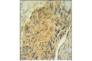 AVP Antibody (Center) (ABIN651748 and ABIN2840385) immunohistochemistry analysis in formalin fixed and paraffin embedded human lung carcinoma followed by peroxidase conjugation of the secondary antibody and DAB staining. (Vasopressin anticorps  (AA 102-129))