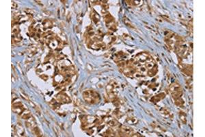 The image on the left is immunohistochemistry of paraffin-embedded Human breast cancer tissue using ABIN7192079(PUS10 Antibody) at dilution 1/45, on the right is treated with synthetic peptide. (PUS1 anticorps)