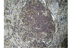 Immunohistochemical analysis of paraffin-embedded human breast carcinoma tissue using Histone H3 (Di-Methyl-Lys27) Antibody.