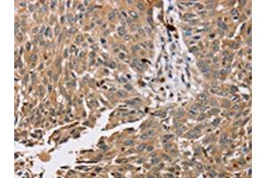 The image on the left is immunohistochemistry of paraffin-embedded Human lung cancer tissue using ABIN7130575(PDLIM7 Antibody) at dilution 1/35, on the right is treated with fusion protein.