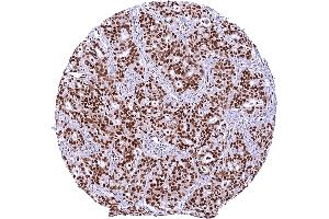 Ovarian serous high grade carcinoma showing a strong GR immunostaining of all tumor cells