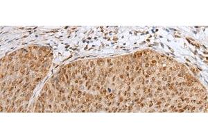 Immunohistochemistry of paraffin-embedded Human cervical cancer tissue using ZNF354A Polyclonal Antibody at dilution of 1:40(x200) (ZNF354A anticorps)