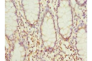 Immunohistochemistry of paraffin-embedded human colon cancer using ABIN7156012 at dilution of 1:100