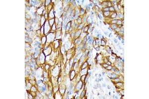 Immunohistochemistry of paraffin-embedded human esophageal cancer using Cytokeratin 6 (KRT6) (KRT6) Rabbit mAb (ABIN1680165, ABIN3019111, ABIN3019112 and ABIN7101717) at dilution of 1:100 (40x lens).