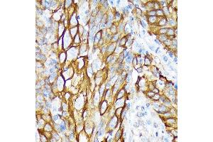 Immunohistochemistry of paraffin-embedded human esophageal cancer using Cytokeratin 6 (KRT6) (KRT6) Rabbit mAb (ABIN1680165, ABIN3019111, ABIN3019112 and ABIN7101717) at dilution of 1:100 (40x lens). (KRT6A anticorps)