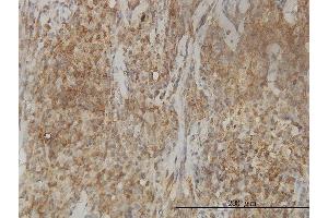 Immunoperoxidase of monoclonal antibody to CAB39L on formalin-fixed paraffin-embedded human lymphoma tissue.