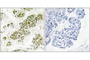 Immunohistochemistry analysis of paraffin-embedded human breast carcinoma tissue, using eIF2 alpha (Ab-51) Antibody. (EIF2A anticorps  (AA 21-70))
