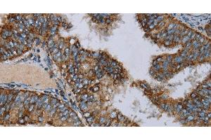 Immunohistochemistry of paraffin-embedded Human colon cancer using NDUFA9 Polyclonal Antibody at dilution of 1:30