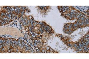 Immunohistochemistry of paraffin-embedded Human colon cancer using NDUFA9 Polyclonal Antibody at dilution of 1:30 (NDUFA9 anticorps)