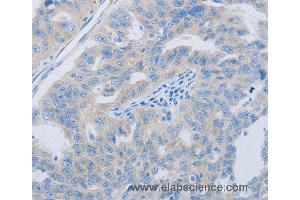 Immunohistochemistry of Human ovarian cancer using PAWR Polyclonal Antibody at dilution of 1:60 (PAWR anticorps)