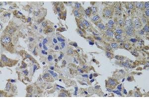 Immunohistochemistry of paraffin-embedded Human breast cancer using GNA15 Polyclonal Antibody at dilution of 1:100 (40x lens). (GNA15 anticorps)