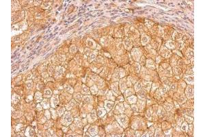 IHC-P Image Apolipoprotein E antibody [C2C3], C-term detects APOE protein at cytosol on human hepatoma by immunohistochemical analysis.