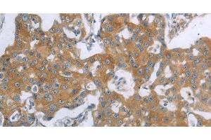 Immunohistochemistry of paraffin-embedded Human breast cancer using TNK2 Polyclonal Antibody at dilution of 1:70 (TNK2 anticorps)