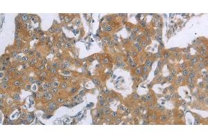 Immunohistochemistry of paraffin-embedded Human breast cancer using TNK2 Polyclonal Antibody at dilution of 1:70