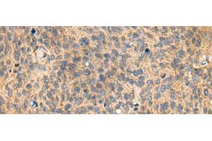 Immunohistochemistry of paraffin-embedded Human cervical cancer tissue using MIA Polyclonal Antibody at dilution of 1:100(x200) (MIA anticorps)