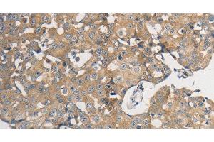 Immunohistochemistry of paraffin-embedded Human breast cancer using PPP2CB Polyclonal Antibody at dilution of 1:50 (PPP2CB anticorps)