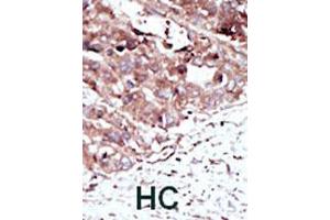 Formalin-fixed and paraffin-embedded human hepatocellular carcinoma tissue reacted with PHKG2 polyclonal antibody  , which was peroxidase-conjugated to the secondary antibody, followed by AEC staining. (PHKG2 anticorps  (N-Term))
