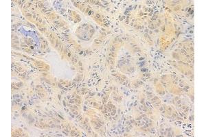 ABIN7096998 and ABIN7101065 at 1/100 staining human lung adenocarcinoma by IHC-P.