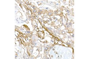 Immunohistochemistry of paraffin-embedded human esophageal cancer using Collagen I/COL1 Rabbit pAb (352) at dilution of 1:150 (40x lens).
