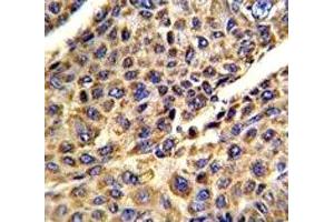 IHC analysis of FFPE human hepatocarcinoma stained with VDAC antibody