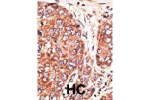 Formalin-fixed and paraffin-embedded human hepatocellular carcinoma tissue reacted with MAFK polyclonal antibody  , which was peroxidase-conjugated to the secondary antibody, followed by AEC staining.