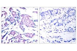 Immunohistochemical analysis of paraffin-embedded human breast carcinoma tissue using c-Jun (phospho-Thr93) antibody (E011022). (C-JUN anticorps  (pThr93))