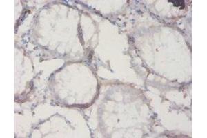 Immunohistochemistry of paraffin-embedded human colon cancer using ABIN7177353 at dilution of 1:20 (IL18BP anticorps  (AA 29-193))