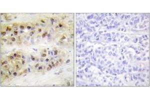 Immunohistochemistry analysis of paraffin-embedded human breast carcinoma tissue, using RORA Antibody. (RORA anticorps  (AA 6-55))