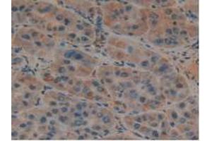 IHC-P analysis of Human Liver Cancer Tissue, with DAB staining. (PLAUR anticorps  (AA 13-114))