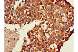 Immunohistochemistry of paraffin-embedded human breast cancer using ABIN7174076 at dilution of 1:100