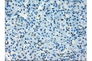 Immunohistochemical staining of paraffin-embedded Adenocarcinoma of colon tissue using anti-NAT8mouse monoclonal antibody. (NAT8 anticorps)