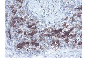 Immunohistochemical staining of paraffin-embedded Adenocarcinoma of Human breast tissue using anti-SERPINB2 mouse monoclonal antibody. (SERPINB2 anticorps)