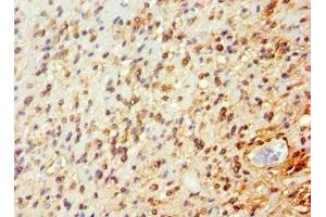 Immunohistochemistry of paraffin-embedded human glioma using ABIN7144651 at dilution of 1:100