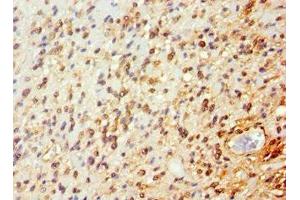 Immunohistochemistry of paraffin-embedded human glioma using ABIN7144651 at dilution of 1:100 (ARNT2 anticorps  (AA 440-690))