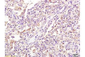 Formalin-fixed and paraffin embedded human pneumonitis tissue labeled with Anti-FPRL1/RFP/Lipoxin A4 receptor Polyclonal Antibody, Unconjugated (ABIN702175) at 1:200 followed by conjugation to the secondary antibody and DAB staining (FPR2 anticorps  (AA 51-150))