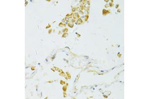 Immunohistochemistry of paraffin-embedded human lung cancer using SIRT2 antibody (ABIN6291363) at dilution of 1:100 (40x lens). (SIRT2 anticorps)