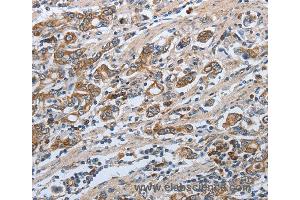 Immunohistochemistry of Human ovarian cancer using SLC34A2 Polyclonal Antibody at dilution of 1:50 (SLC34A2 anticorps)