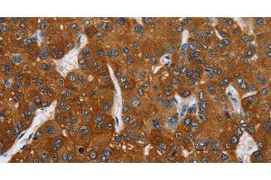 Immunohistochemistry of paraffin-embedded Human liver cancer tissue using CARD9 Polyclonal Antibody at dilution 1:70 (CARD9 anticorps)