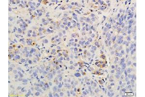 Formalin-fixed and paraffin embedded rat hepatoma labeled with Anti-CXCR2/CD182 Polyclonal Antibody, Unconjugated (ABIN732218) followed by conjugation to the secondary antibody and DAB staining (CXCR2 anticorps  (AA 316-360))
