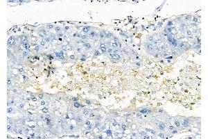 ABIN6258088 and ABIN6273896 at 1/100 staining Human liver cancer by IHC-P. (GPR81 anticorps  (C-Term))