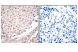 Immunohistochemical analysis of paraffin-embedded human lung carcinoma tissue using Cullin 1 antibody.