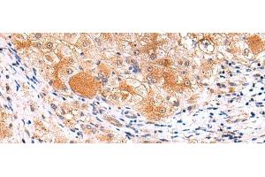 Immunohistochemistry of paraffin-embedded Human liver cancer tissue using ITSN2 Polyclonal Antibody at dilution of 1:40(x200) (Intersectin 2 anticorps)