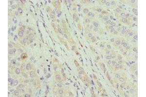 Immunohistochemistry of paraffin-embedded human liver cancer using ABIN7144067 at dilution of 1:100