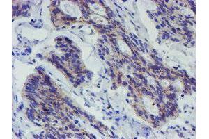 Immunohistochemical staining of paraffin-embedded Carcinoma of Human pancreas tissue using anti-LRRC25 mouse monoclonal antibody. (LRRC25 anticorps)