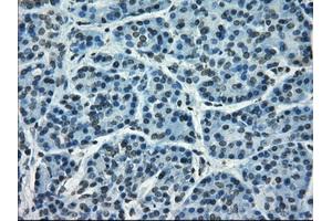 Immunohistochemical staining of paraffin-embedded Adenocarcinoma of breast tissue using anti-CRYAB mouse monoclonal antibody. (CRYAB anticorps)