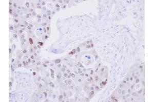 IHC-P Image Immunohistochemical analysis of paraffin-embedded H441 Xenograft, using DNA ligase 3, antibody at 1:100 dilution.