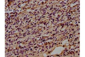 IHC image of ABIN7160185 diluted at 1:100 and staining in paraffin-embedded human lung cancer performed on a Leica BondTM system.