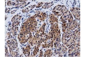 Immunohistochemical staining of paraffin-embedded Carcinoma of Human kidney tissue using anti-CBWD1 mouse monoclonal antibody. (CBWD1 anticorps)