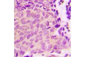 Immunohistochemical analysis of TSC2 (pS939) staining in human breast cancer formalin fixed paraffin embedded tissue section.
