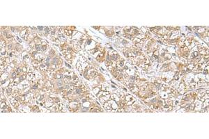 Immunohistochemistry of paraffin-embedded Human liver cancer tissue using EIF1AY Polyclonal Antibody at dilution of 1:55(x200)